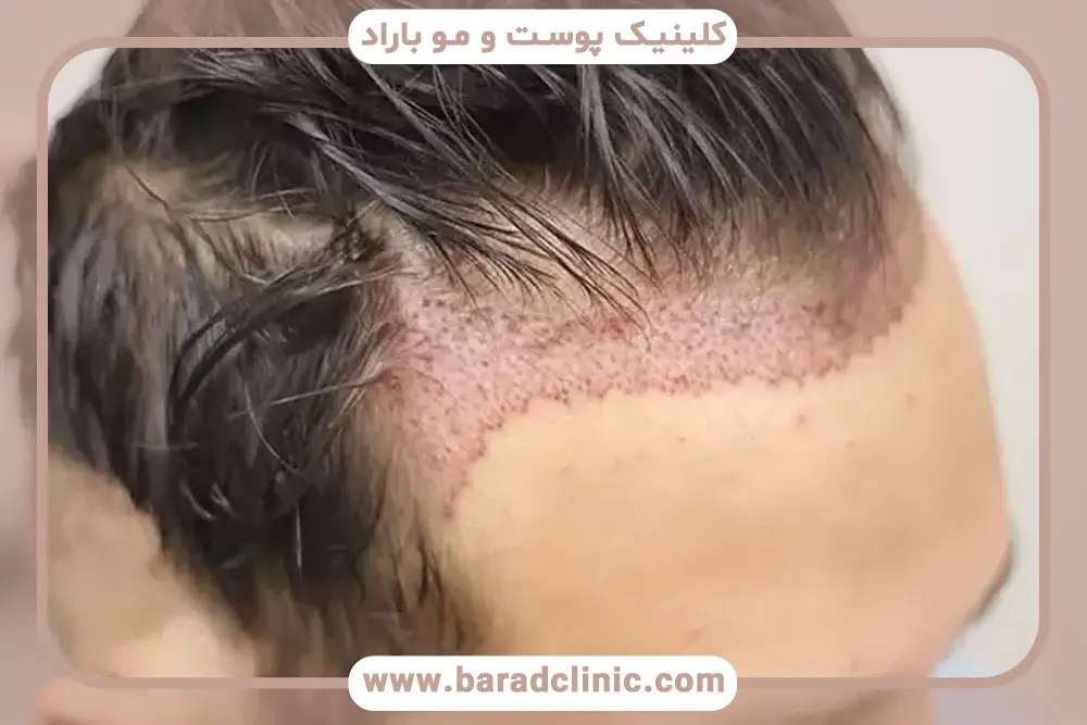 علائم مهم در عکس زخم کاشت مو
