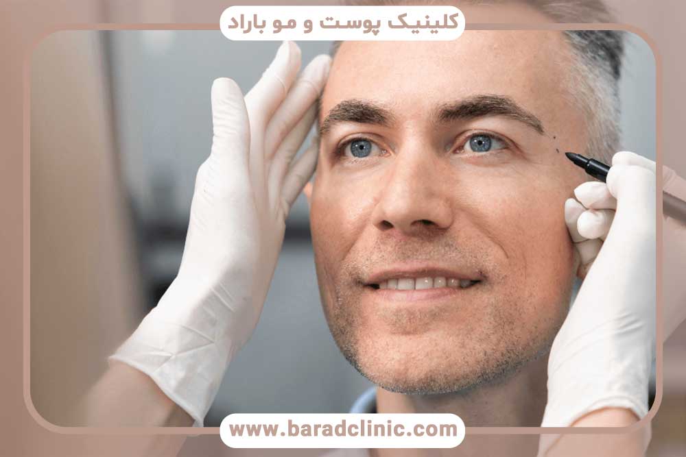 کاشت ابرو مردانه قسطی