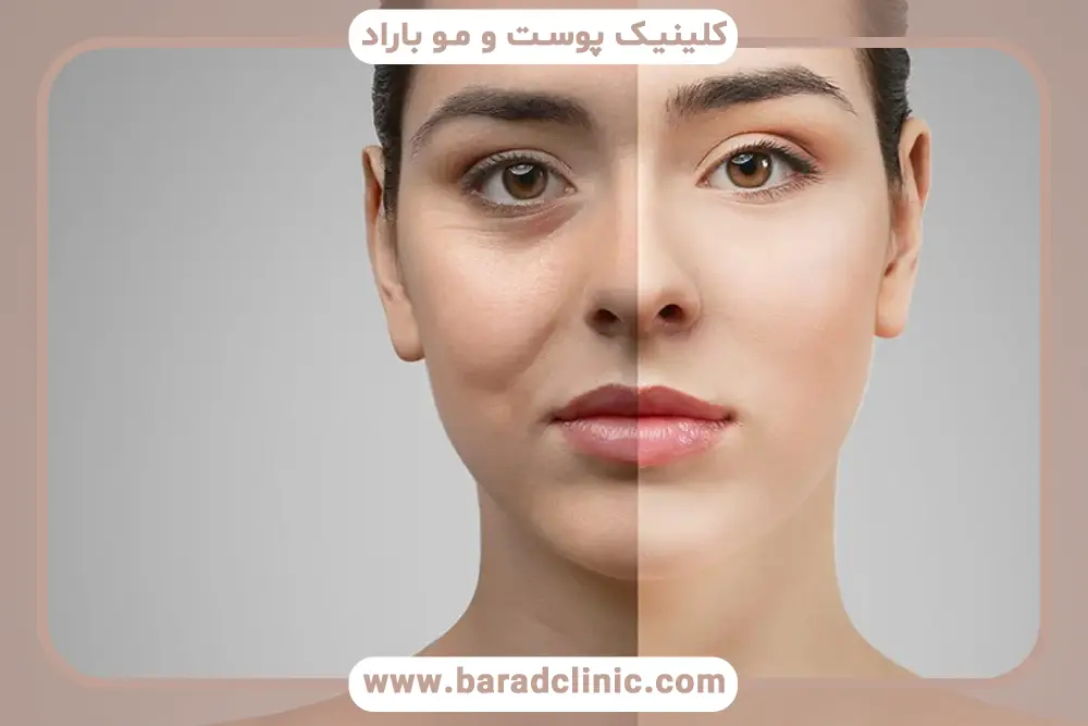 تاثیر دستمزد جراح روی هزینه عمل بلفاروپلاستی تهران