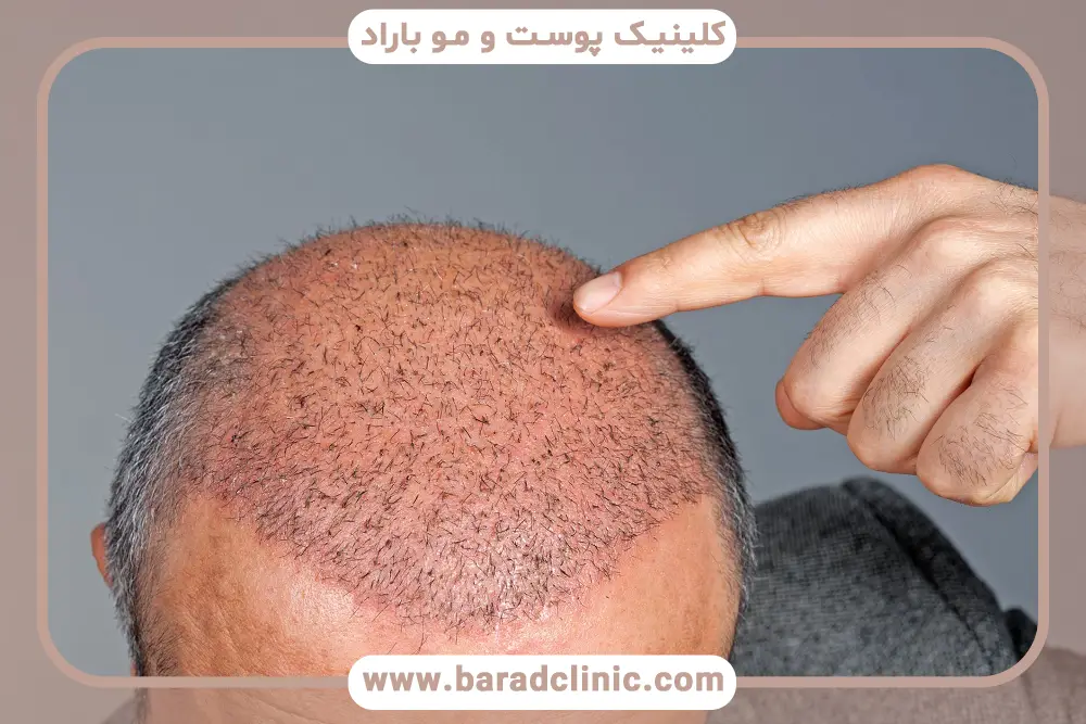 مدت زمان مصرف قرص هیرویت بعد از کاشت مو