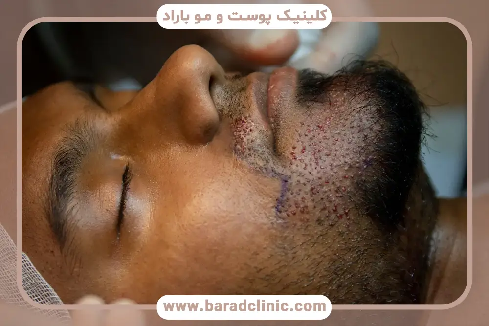 آشنایی با بانک مو مناسب برای کاشت ریش 