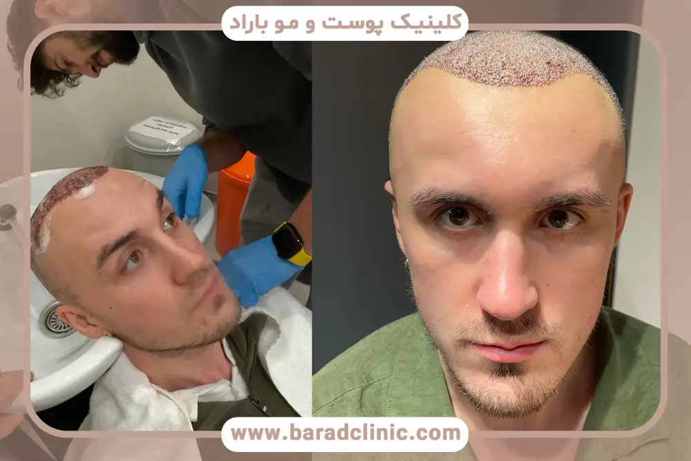 نقش تخصص پزشک در کاهش عوارض کاشت مو در مردان