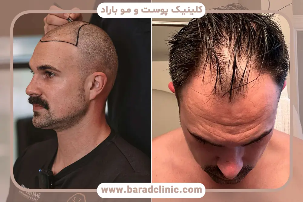 بررسی روش کاشت در نمونه کاشت مو 