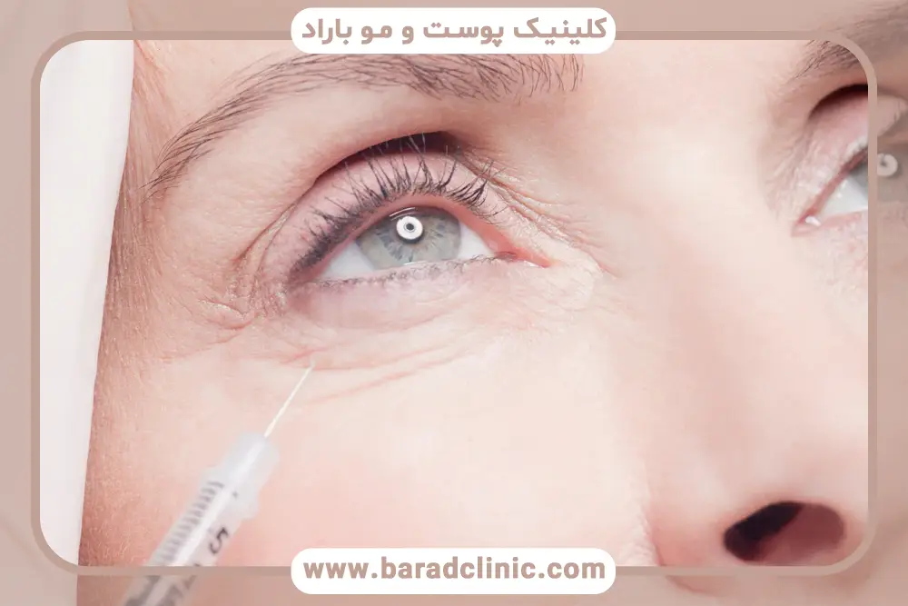 مراقبت‌های قبل و بعد prp برای زیر چشم