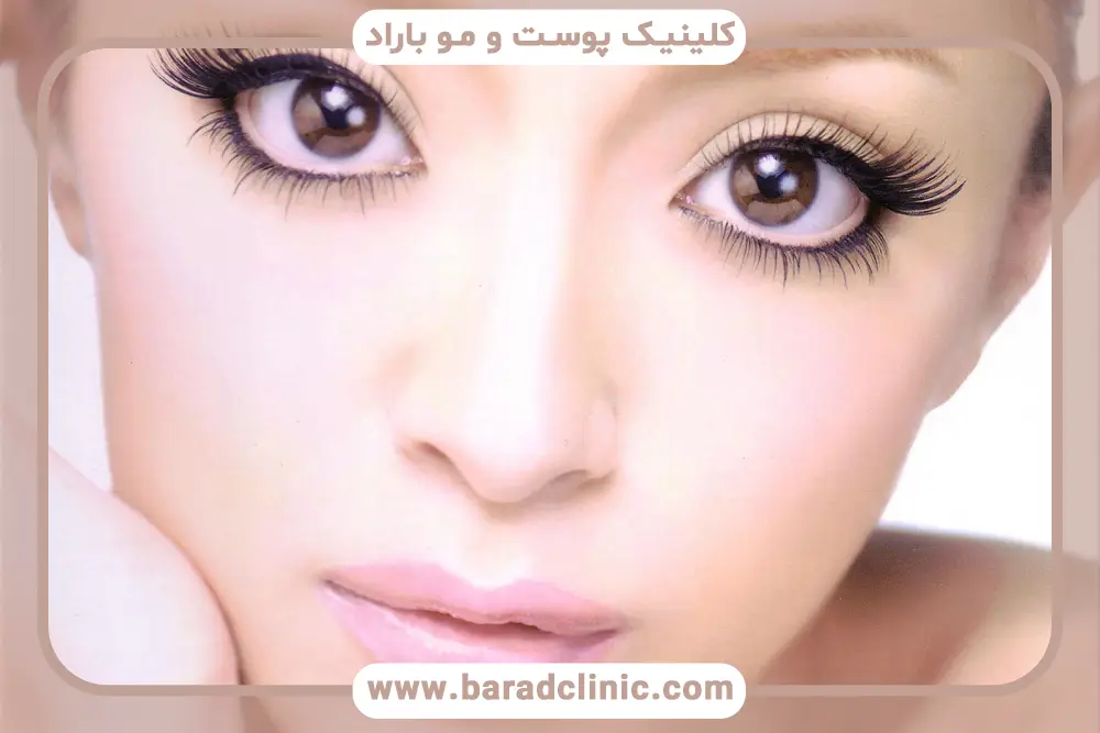 موارد جانبی هزینه جراحی بلفاروپلاستی تحتانی غرب تهران