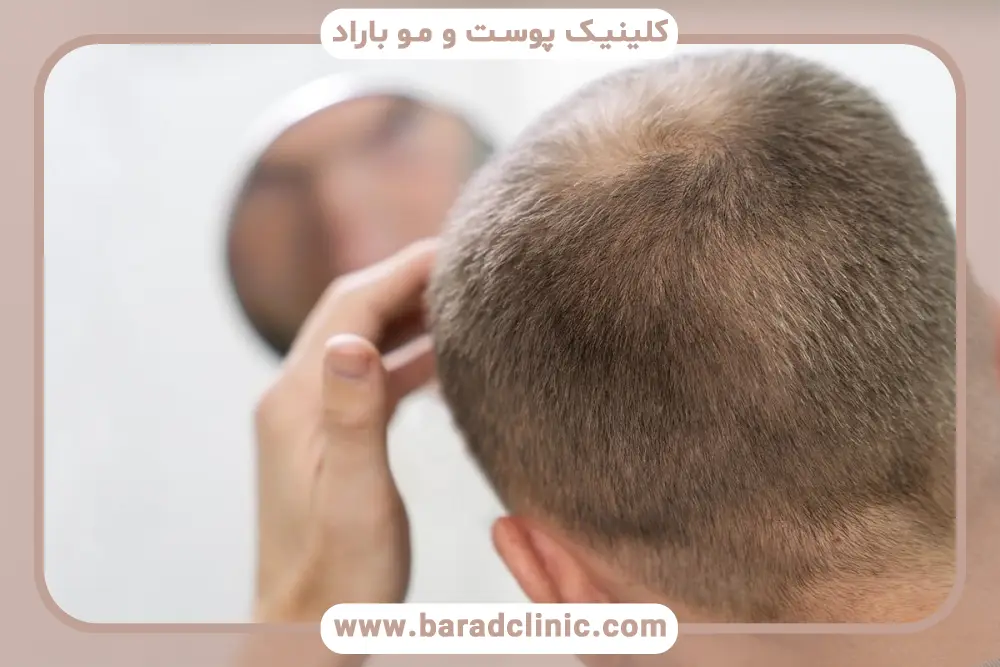 مزایا و معایب کاشت مو کم پشت