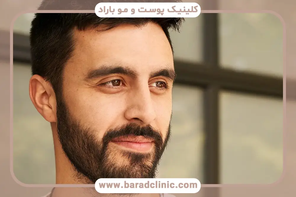 مراقبت‌های ضروری برای افزایش ماندگاری کاشت ریش