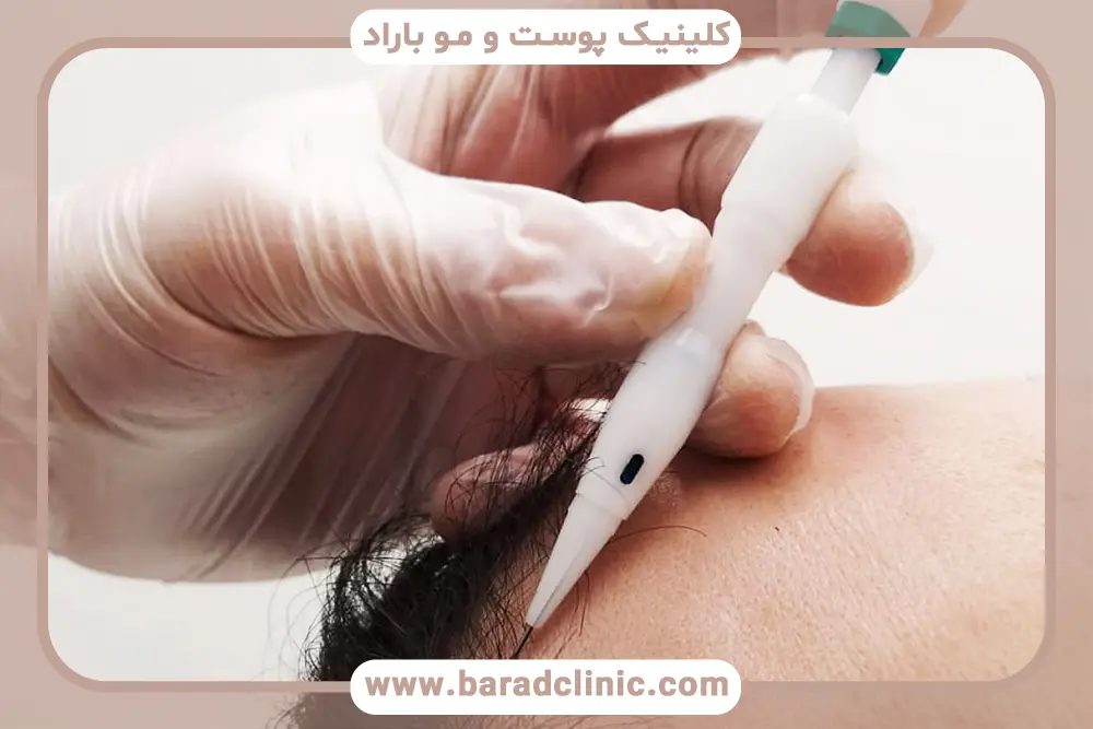 ابزار کاشت مو برای طراحی خط رویش