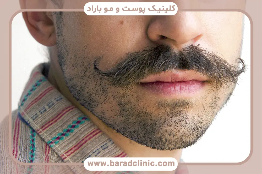 تاثیر مراقبت‌ها روی هزینه کاشت سبیل در تهران