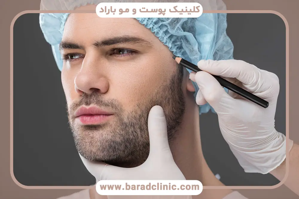 کیفیت گرافت‌ها در تعیین تعداد گرافت مو برای کاشت ریش