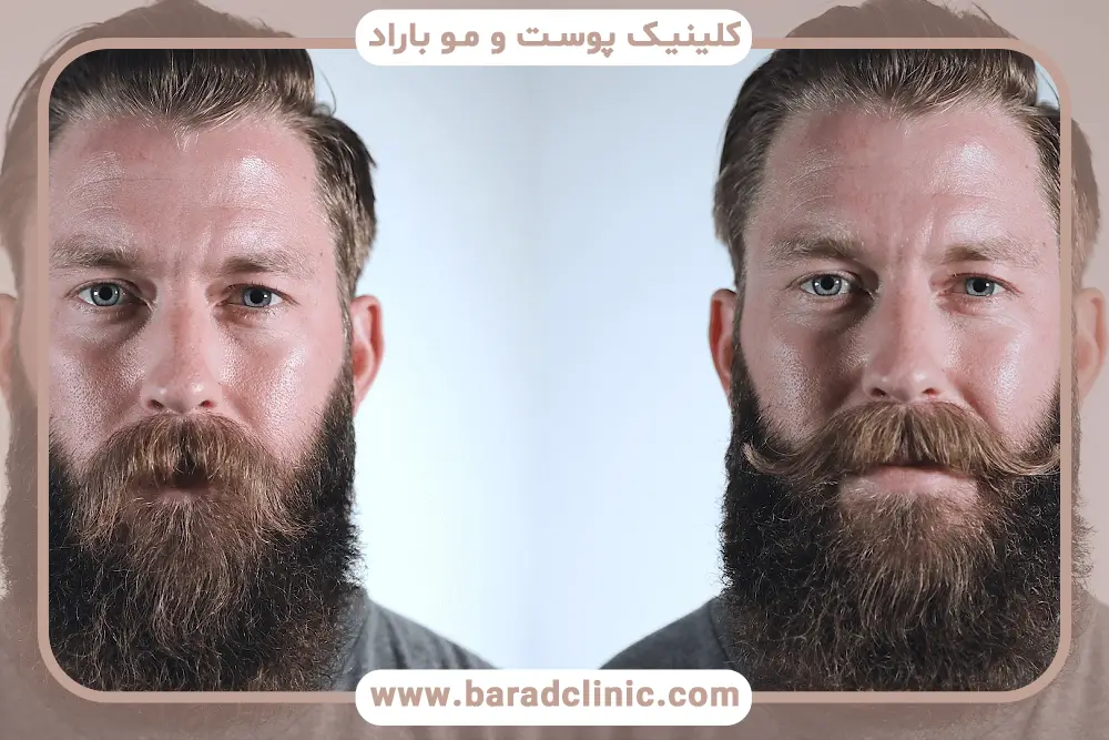 نکات مهم درباره هزینه کاشت سبیل در شمال تهران