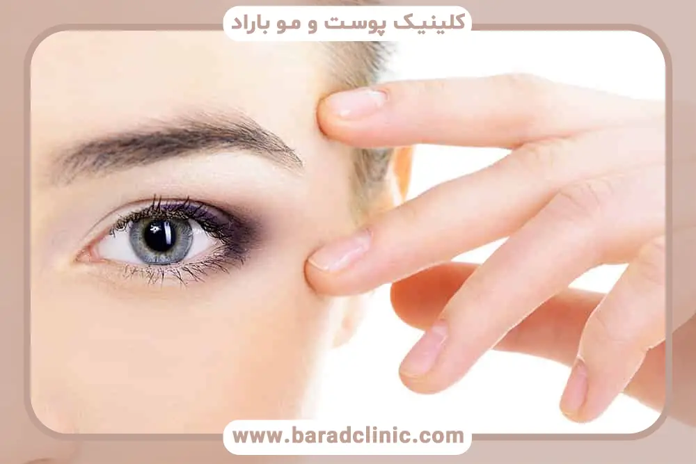 هزینه جانبی جراحی بلفاروپلاستی فوقانی تهران