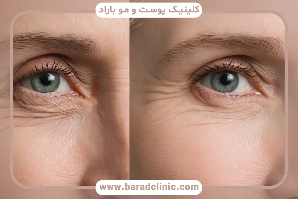 ماندگاری بوتاکس زیر چشم