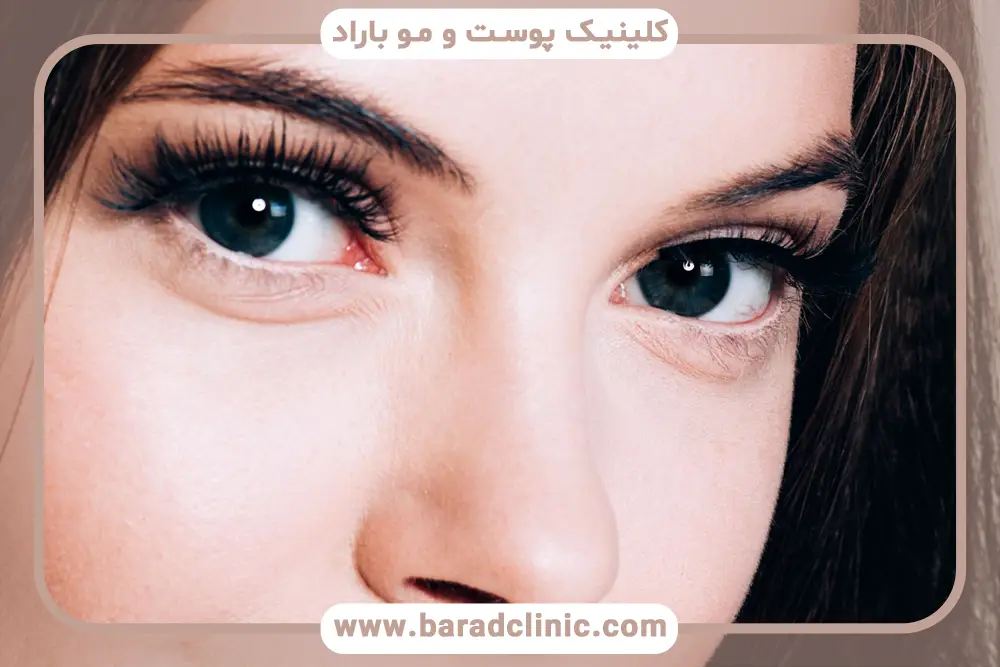 تاثیر روش عمل روی هزینه عمل بلفاروپلاستی غرب تهران