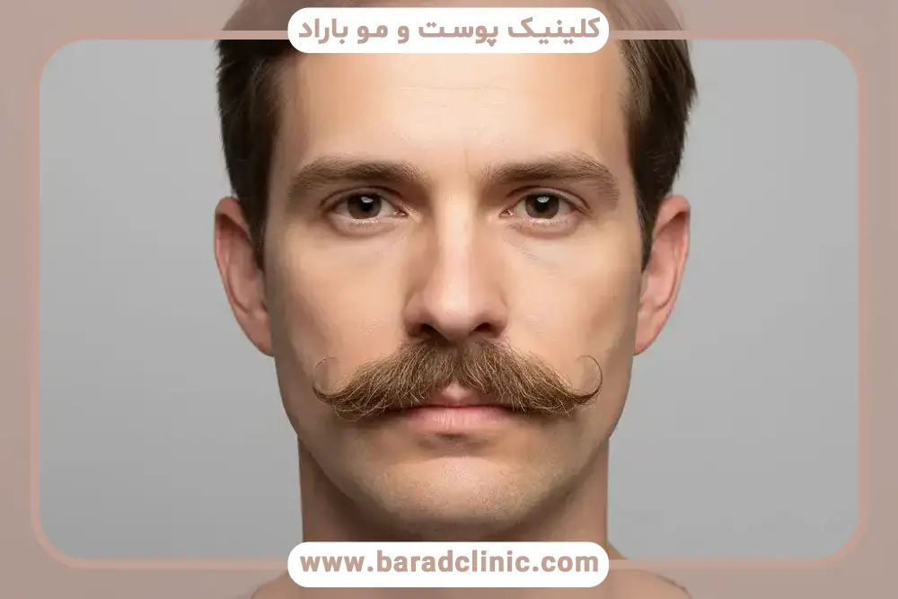 مراقبت‌های قبل و بعد کاشت سبیل