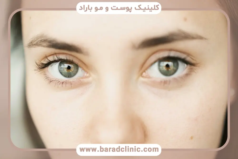 هزینه بلفاروپلاستی با لیزر تهران