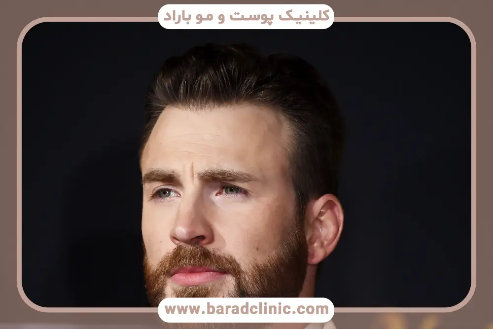 مراقبتهای بعد از کاشت سبیل اقساطی