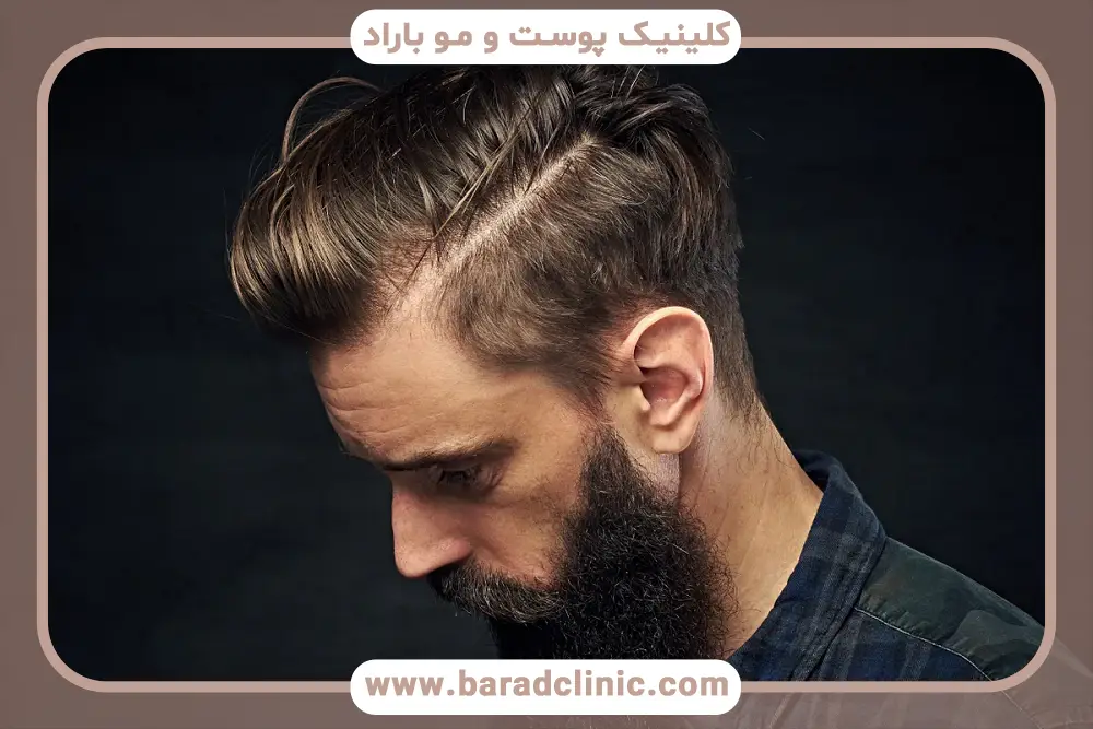 کاشت فولیکول‌ها در پروسه کاشت مو