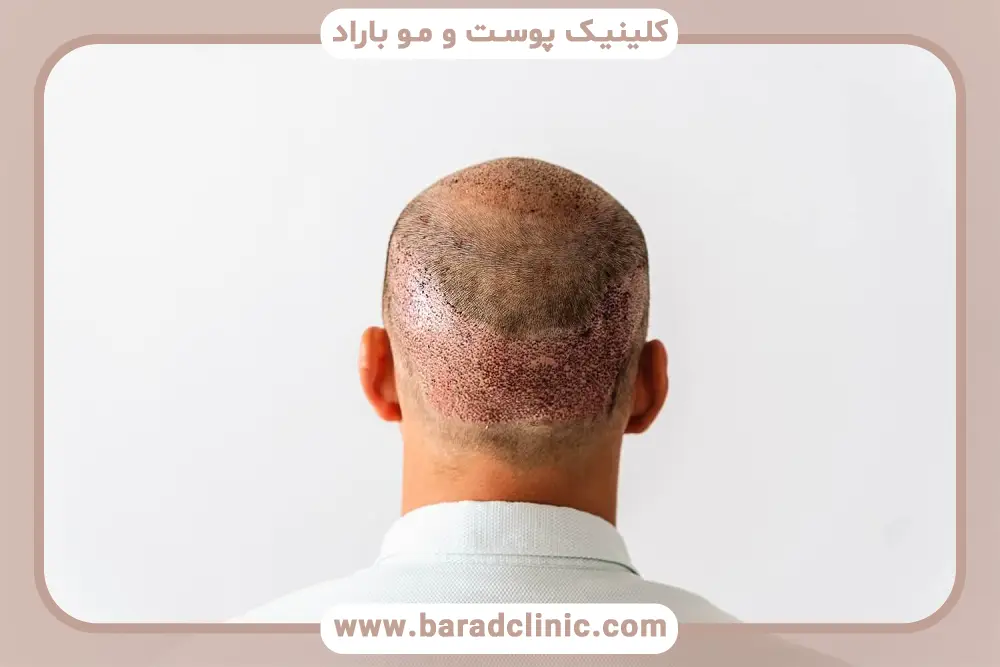 تاثیر مراقبت‌ها در عکس زخم کاشت مو