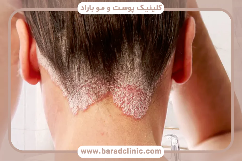 پسوریازیس پوست سر و ریزش مو