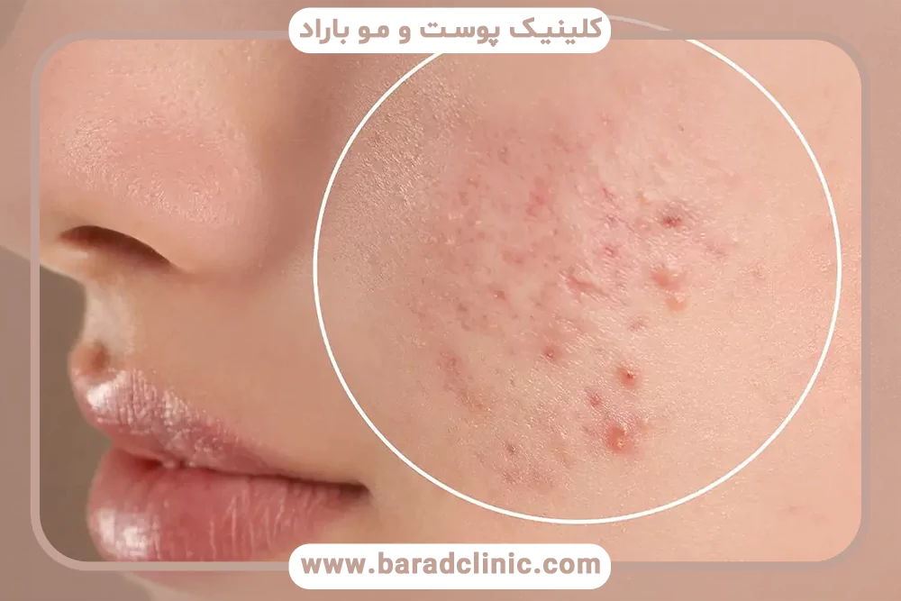 آکنه و علت ایجاد