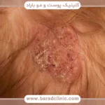 قارچ پوست سر (Tinea Capitis)