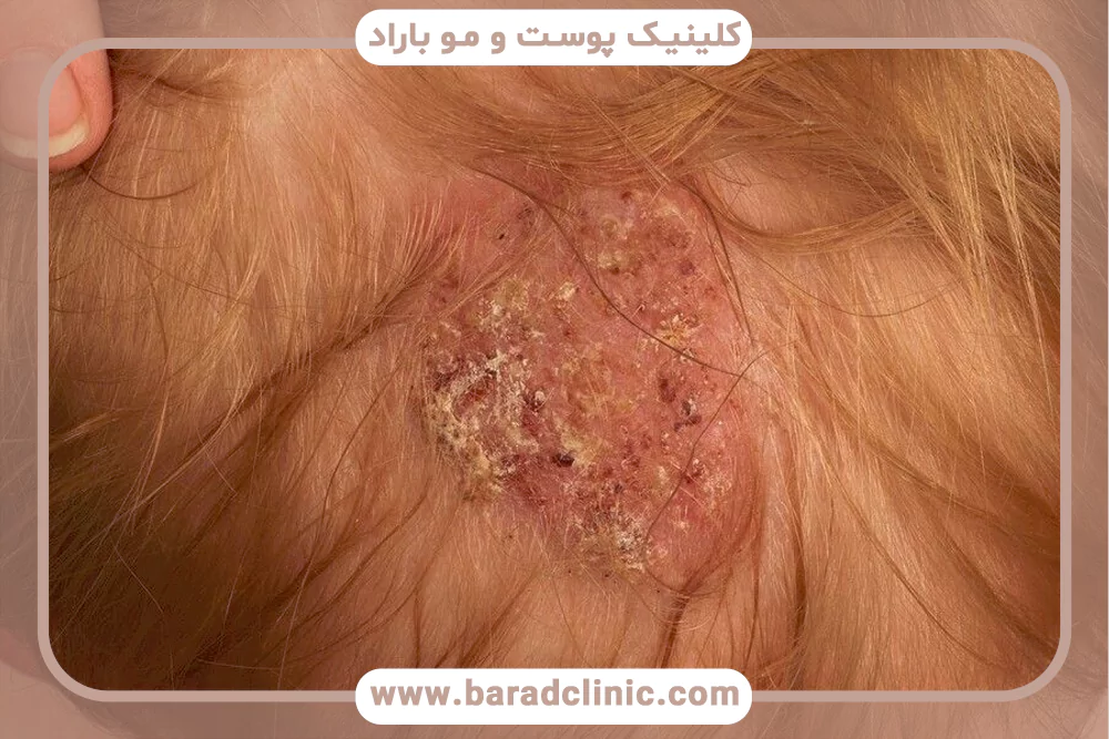 قارچ پوست سر (Tinea Capitis)