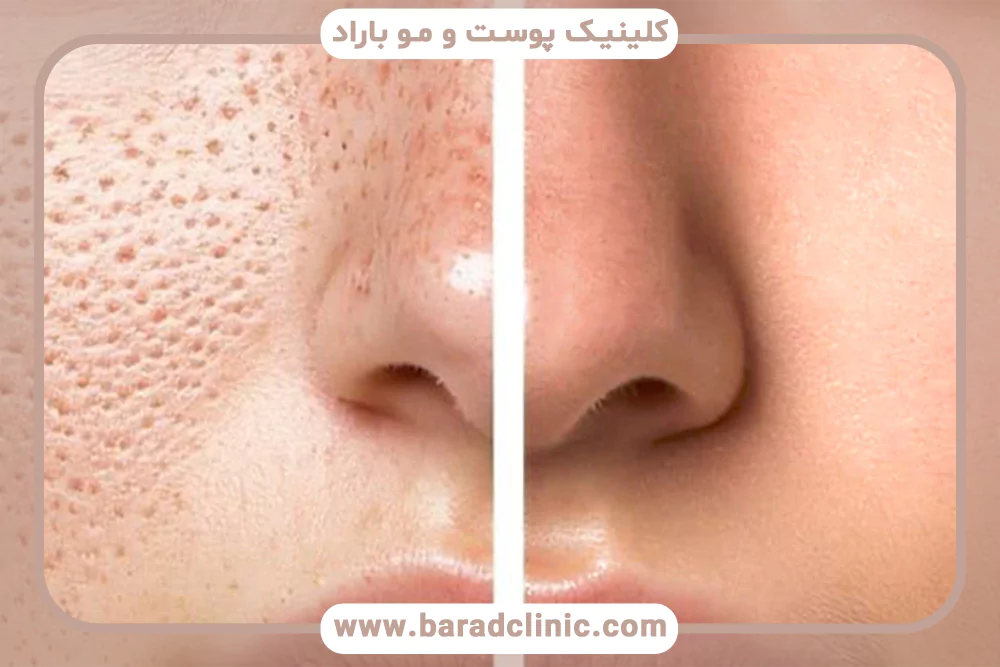 منافذ باز پوست