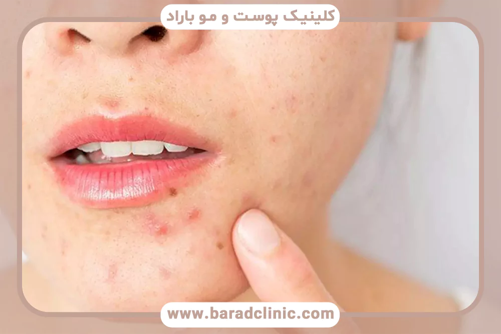 نقش انسولین و مقاومت انسولینی در جوش صورت