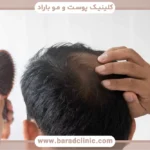 دلایل ریزش مو در مردان