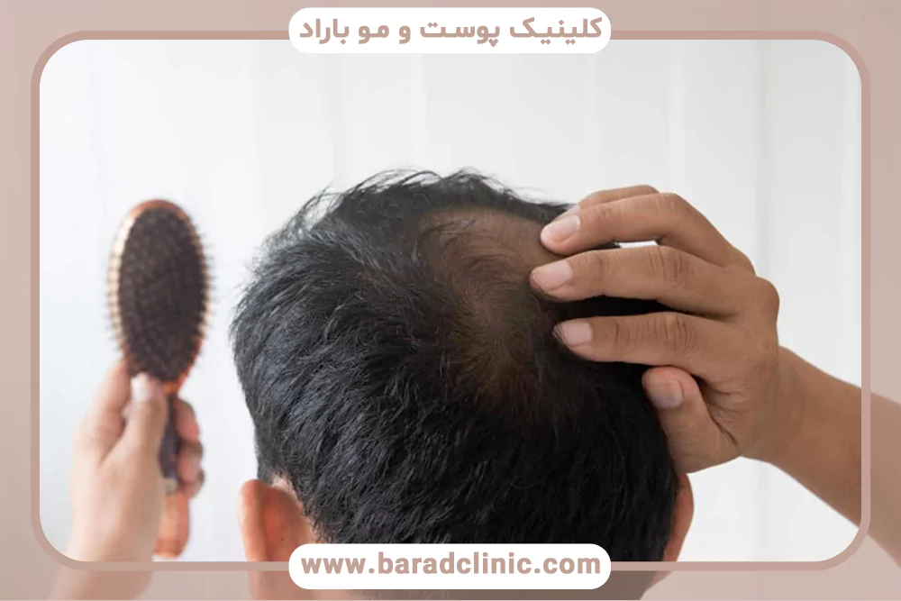 دلایل ریزش مو در مردان