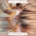 التهاب پوست سر