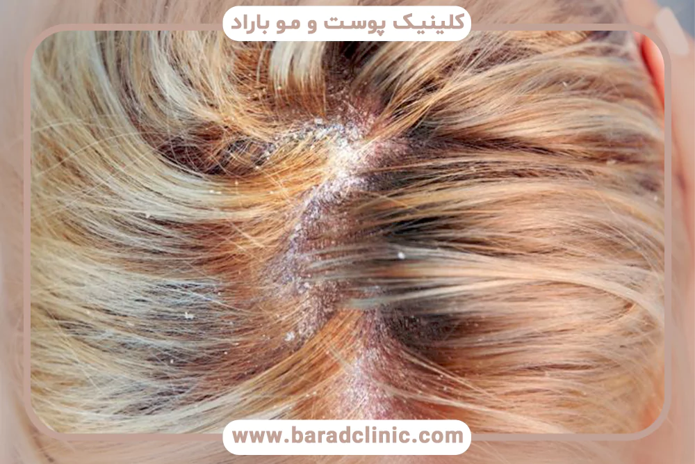 التهاب پوست سر