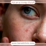 کورتیزول و پوست؛ چگونه استرس مزمن روند پیری را تسریع می‌کند؟