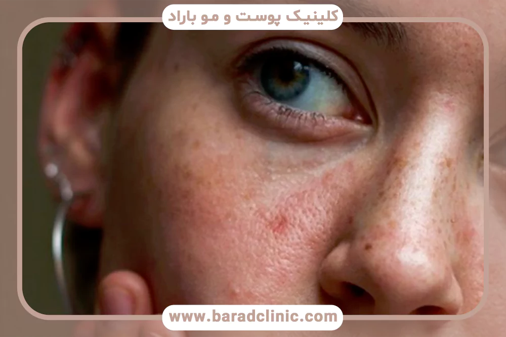 کورتیزول و پوست؛ چگونه استرس مزمن روند پیری را تسریع می‌کند؟