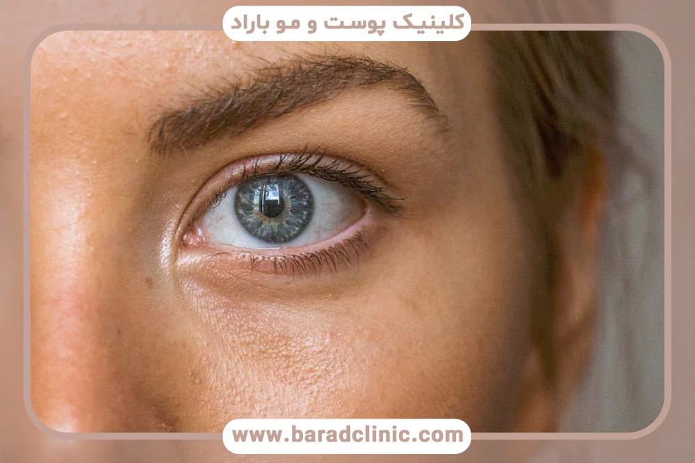 تأثیر تخمدان پلی‌کیستیک بر پوست و مو