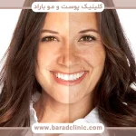 تاثیر آفتاب بر پیری پوست