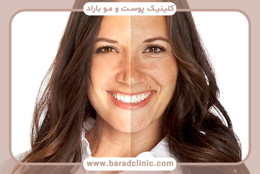 تاثیر آفتاب بر پیری پوست