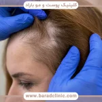 پدیده Shedding درمانی مو