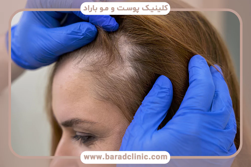 پدیده Shedding درمانی مو