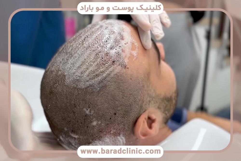 انتخاب شامپو بعد از کاشت مو