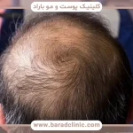 حد توقف درمان ریزش مو