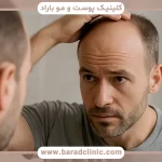 استرس اکسیداتیو و ریزش مو
