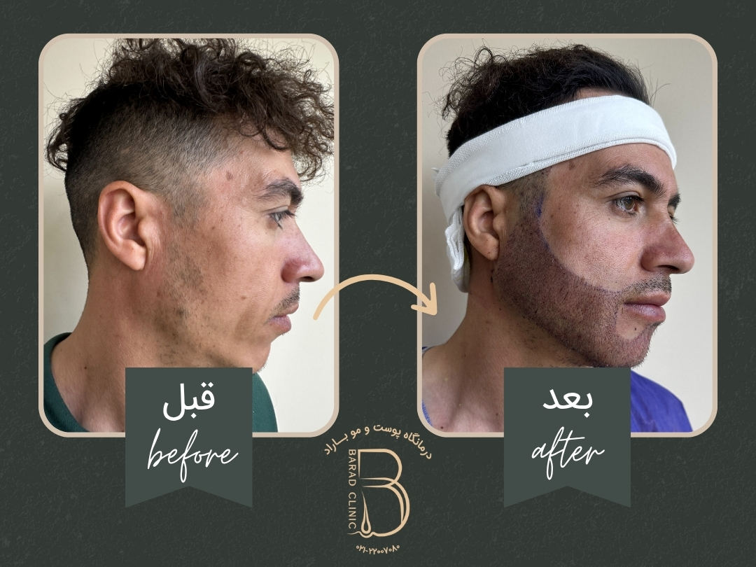 کاشت ریش و سبیل کامل مردانه در کلینیک باراد
