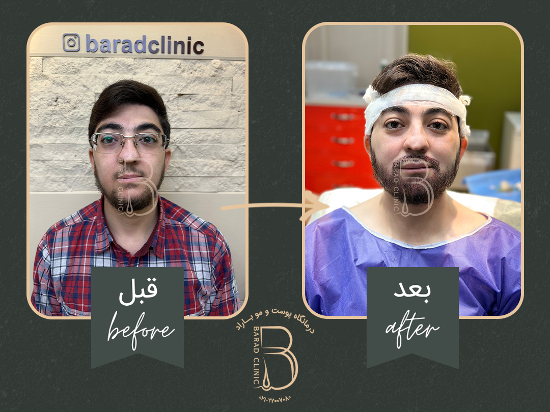 کاشت ریش و سبیل در کلینیک باراد