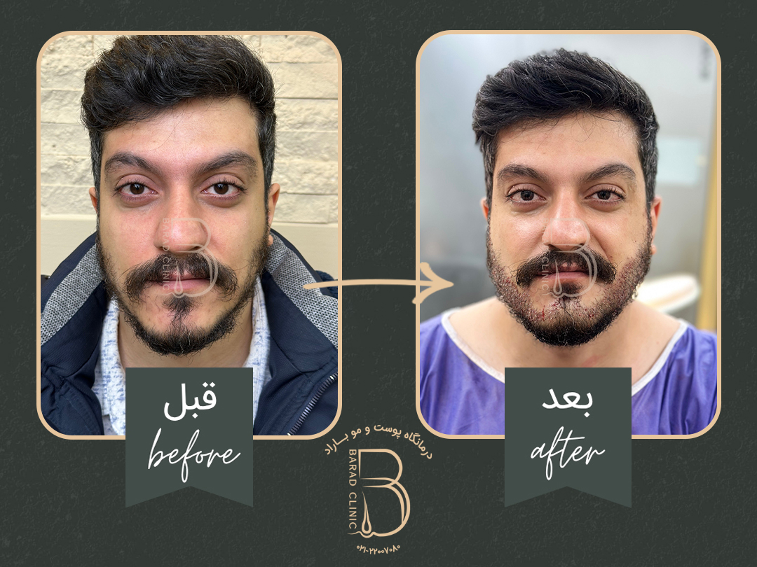 کاشت ریش و سبیل مردانه در کلینیک باراد