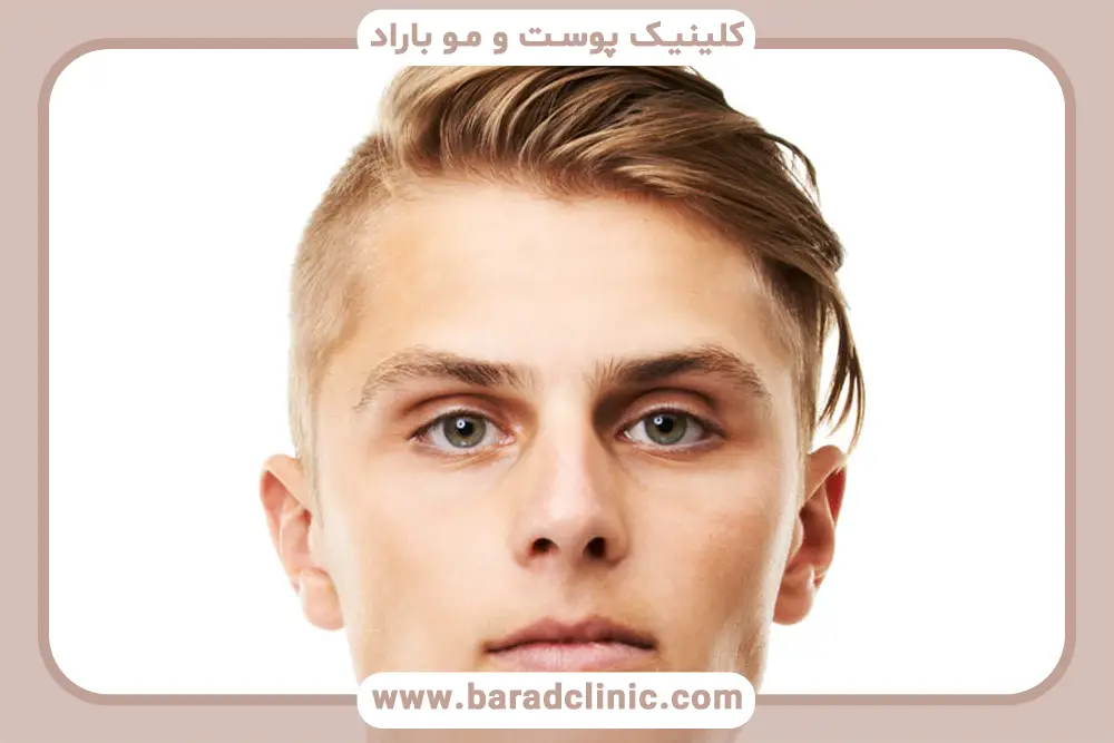 خوردن قهوه بعد از کاشت مو