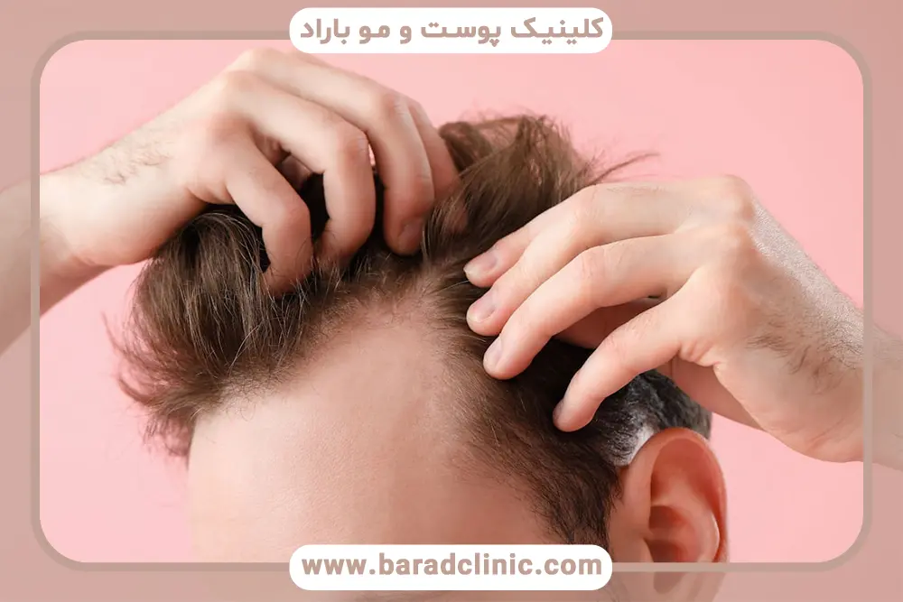 آیا کاشت مو ارزان انتخاب درستی است؟