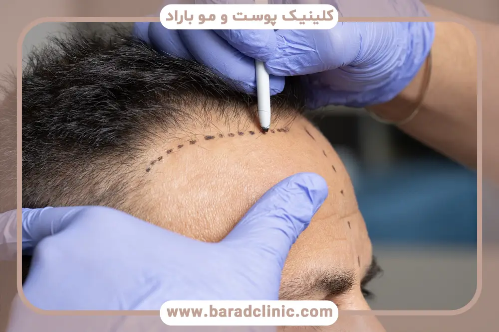 شامپو بعد از کاشت مو ژاک آندرل