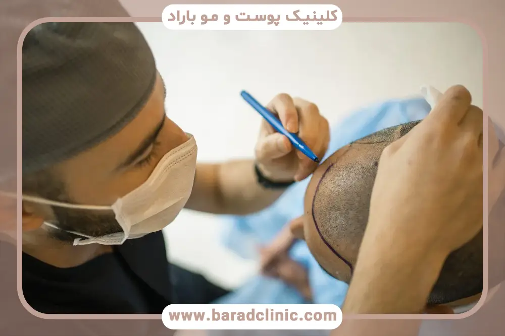 چربی سر بعد از کاشت مو